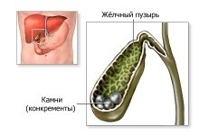 Cum se determina calculi biliari (determinat) Cum de a identifica calculi biliari