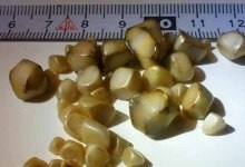 Cum de a determina calculi biliari (pietre) Cum de a identifica calculi biliari