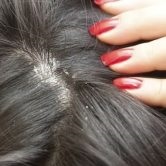 Dandruff Shampoo cum să selectați agentul optim (e) sampon medicamentat pentru matreata cum de a alege cele mai bune mijloace
