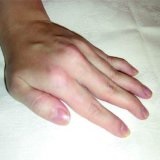 remedii sindromul Raynaud Tratament popular - bisturiu - informații medicale și educație (tratament) remedii populare Raynaud Sindromul de tratament - bisturiu - informații medicale și educație