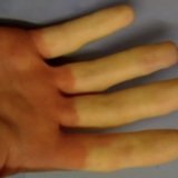 remedii populare Sindromul Raynaud Tratament - bisturiu - informații medicale și educație (Reynaud) remedii populare Raynaud Sindromul de tratament - bisturiu - informații medicale și educație