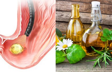 Tratamentul ulcerului gastric remedii populare si dieta, medicina populară (răni) Tratamentul ulcerului gastric remedii populare si dieta, medicina populară
