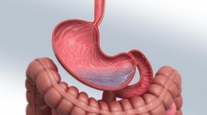 Tratamentul ulcerului gastric remedii populare si dieta, medicina populară (răni) Tratamentul ulcerului gastric remedii populare si dieta, medicina populară