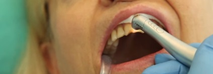 cu laser tratament dentar în Novgorod inferior - tratament cu laser dentar (tratament cu laser dinți) cu laser tratament stomatologic în Novgorod inferior - stomatologia cu laser