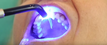 cu laser tratament dentar în Novgorod inferior - tratate cu laser dinți (dinți) cu laser tratament stomatologic în Novgorod inferior - stomatologia cu laser