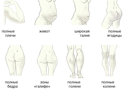 lipoaspiratiei zone ale corpului (pantaloni liposuctie Zone și alte zone cu probleme ale corpului) zone ale corpului Liposucție