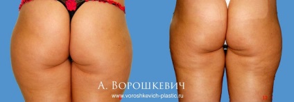 zone ale corpului Liposucție (hrana spital de îngrijire de zi) zone ale corpului Liposucție