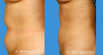 zonele corpului liposucție (zile spitalizare de îngrijire nutriție) zone ale corpului Liposucție