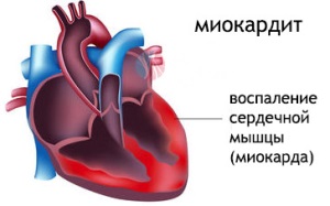 Miocardita - etiologie, patogeneza, diagnosticul, tratamentul, prevenirea, sănătate și medicină (etiologie) Miocardita - etiologie, patogeneza, diagnostic, tratament, prevenire, sănătate și medicină
