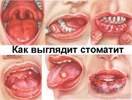 Nistatina cu numirea stomatită, contraindicații (Nystatin) Nistatina cu numirea stomatită, contraindicații