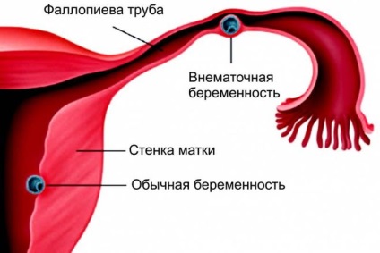 Ai nevoie de îndepărtarea tubului de sarcină ectopică (oviducî) Ai nevoie de tub de ștergere sarcină ectopică