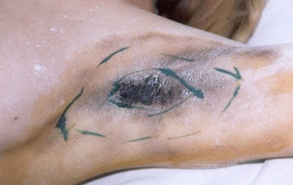 Chirurgie pentru a elimina glandele sudoripare - tehnicilor, eficacitate, complicatii (indepartarea subraț glandele sudoripare chirurgie cu laser pe picioare mâinile sub axile) Chirurgie pentru a elimina glandele sudoripare - metode de punere în aplicare, eficacitate, complicații