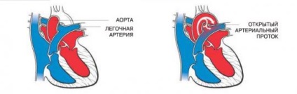Simptomele canalului arterial, diagnostic și tratament (conductă) Canalului arterial Simptome, diagnostic și tratament