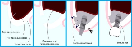 operație de ridicare sinus exterior (ridicare) chirurgie de ridicare deschis sinus
