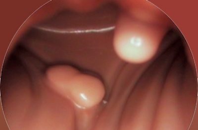 Polip endometrului în uter determină că este, cum să se vindece fără operație (e) pentru polip endometrului în uter cauzează ceea ce este ca să fie tratate fără intervenție chirurgicală