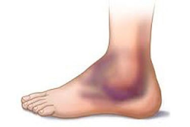 Dupa un picior fractura glezna umfla (glezna) După o fractură glezna piciorului gonflează