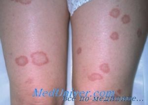 Cauzele și tratamentul necrobiosis lipidelor (cauza) Cauzele și tratamentul necrobioză lipidelor