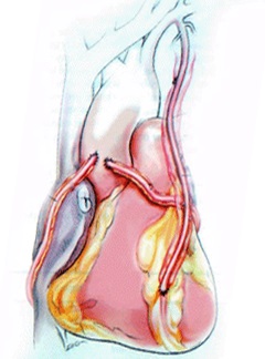 Progresivă angina - cauze, simptome, diagnostic si tratament (cauza) Progresivă angina - cauze, simptome, diagnostic și tratament