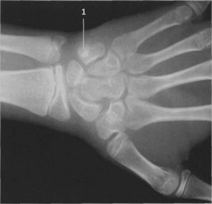 Wrist cu raze x probe, comportament, descrierea și rezultatele (cu perii) Încheietura X-ray probe, comportament, descrierea și rezultatele