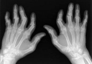 pas radiografice semne de artrita reumatoida si simptome (etapa) pas radiografice semnelor și simptomelor artritei reumatoide