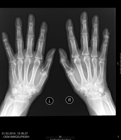 hands raze X, diagnostic, contraindicații (raze X) mâinile cu raze X, diagnostic, contra