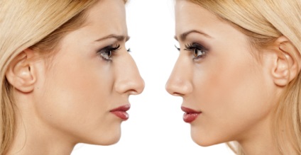 Rinoplastia la Moscova prețurile pentru nas de plastic în clinici ea (rinoplastie) Rinoplastia la Moscova prețurile pentru nas de plastic în clinici ea