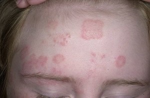 Cauzele impetigo, simptome și tratament (tratament) Cauze impetigo, simptome și tratament