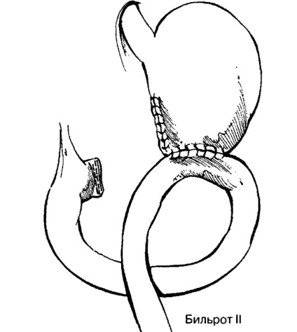 Subtotal gastrectomie - distal, proximal Billroth 2 (stomac) Subtotal gastrectomie - distal, Billroth proximal 2