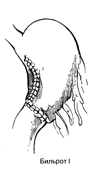 Subtotal gastrectomie - distal, proximal Billroth 2 (Billroth) Subtotal gastrectomie - distal, Billroth proximal 2