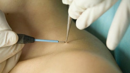 Îndepărtarea cu laser nev chirurgicale si alte tehnici (text eliminat) chirurgie nev cu laser îndepărtarea și alte metode
