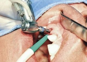 Instalarea implantului imediat după extracția dentară! (Once) Instalarea implantului imediat după extracția dentară!