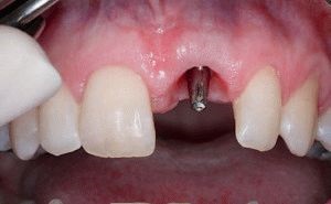Instalarea implantului imediat după extracția dentară! (Instalarea implantului imediat după extracția unui dinte) Instalarea implantului imediat după extracția dentară!
