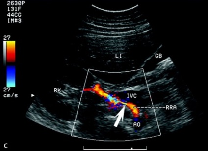 arterele UZDG cerebrale, vasculare cu ultrasunete Doppler Mage (cap) Ecografie Doppler a principalelor artere ale capului, Doppler vascular cu ultrasunete magician