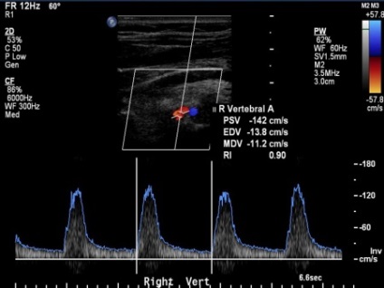 UZDG arterele cerebrale, Doppler vascular ultrasunete mage (cu ultrasunete) Ecografie Doppler a principalelor artere ale capului, Doppler vascular cu ultrasunete magician