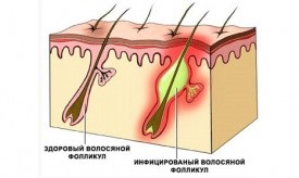 Inflamația tratamentului foliculului pilos (inflamație) Inflamația tratamentului foliculului pilos