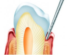 Necrotizanta gingivita ulcerativă - înfrângerea gingiilor - poate fi cel mai bun site pentru stomatologie (poate) Necrotizanta ulcerativa gingivita - gingii înfrângere - probabil cel mai bun site pentru stomatologie