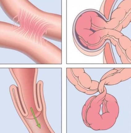 Constipație cu pancreatită - ce să facă, cauza si tratament (review-uri) (do) Constipație cu pancreatită - ce să facă, cauza si tratament (comentarii)