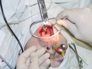 Vegetații adenoide si alergii - simptome ale cauzei și cum să le trateze (vegetații adenoide) Vegetații adenoide si alergii - simptome ale cauzei și cum să le trateze