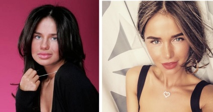 Alex contur de buze de plastic rinoplastie și cântăreț, foto înainte și după (Alex înainte și după Rinoplastia) Alex contur buze de plastic și cântăreață rinoplastie, fotografii înainte și după