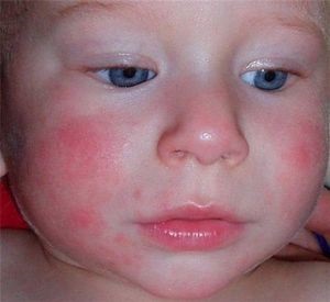 Alergia la pui la sugari (pui) Alergia la pui la sugari