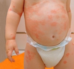 Alergia la pui simptomelor si tratamentul copilului (tratament) Alergia la pui simptomelor si tratamentul copilului