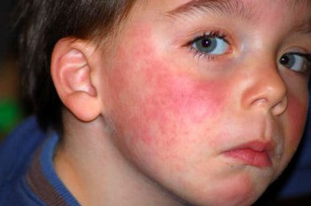 Alergic la citrice - simptome, tratament, foto (alergie) Alergic la citrice - simptome, tratament, fotografii