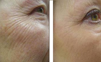 Blefaroplastia alternativă (chirurgia pleoapelor) - cele mai populare metode de masaj, Thermage (popular) Blefaroplastia alternativă (chirurgia pleoapelor) - cele mai populare metode de masaj, Thermage