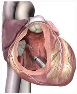 bătăi neregulate ale inimii (aritmie) aritmie cardiacă