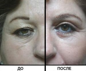vizionări Blefaroplastia secolului, fotografie, contraindicații (foto) views secolul Blefaroplastia, fotografie, contraindicații