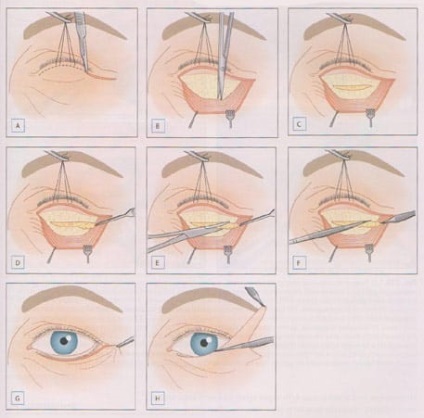 vizionări Blefaroplastia secolului, fotografie, contraindicații (blefaroplastie) views secolul Blefaroplastia, fotografie, contraindicații