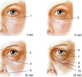 vizionări Blefaroplastia secolului, fotografie, contraindicații (blefaroplastie) views secolul Blefaroplastia, fotografie, contraindicații