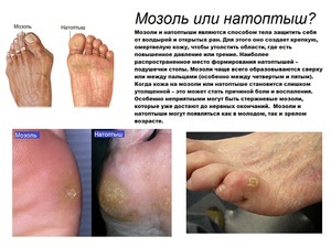 Boli ale picioarelor la copii și adulți (picior de tratament picior boala simptom al bolilor umane) Boli ale picioarelor la copii și adulți