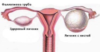 Durerea la femei cauze, simptome (coloanei vertebrale lombare) femei spate provoaca durere, simptome
