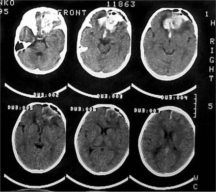 leziuni cerebrale traumatice la copii (copii) leziuni cerebrale traumatice la copii